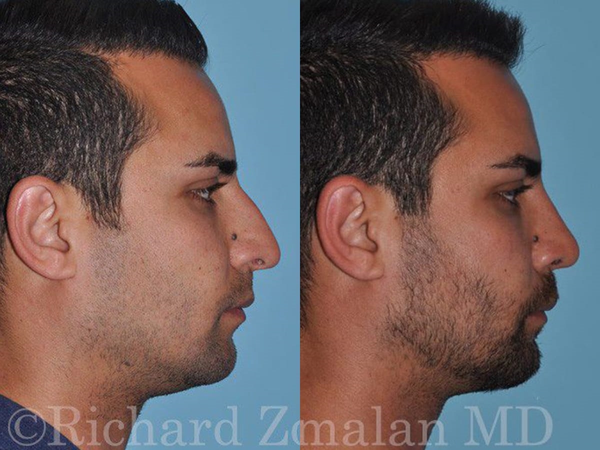 rhinoplasty doctor