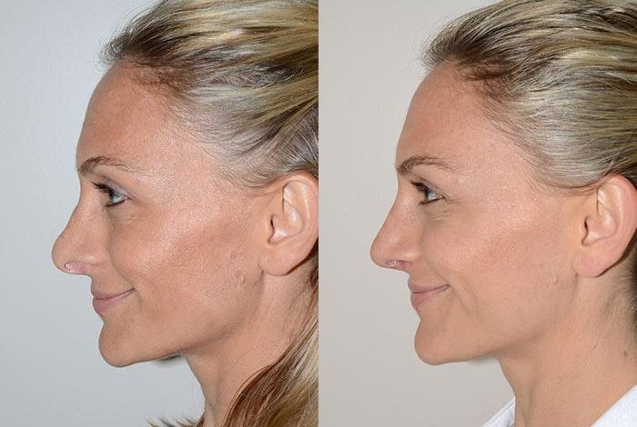 Rinoplastica a Milano – rhinoplasty doctor